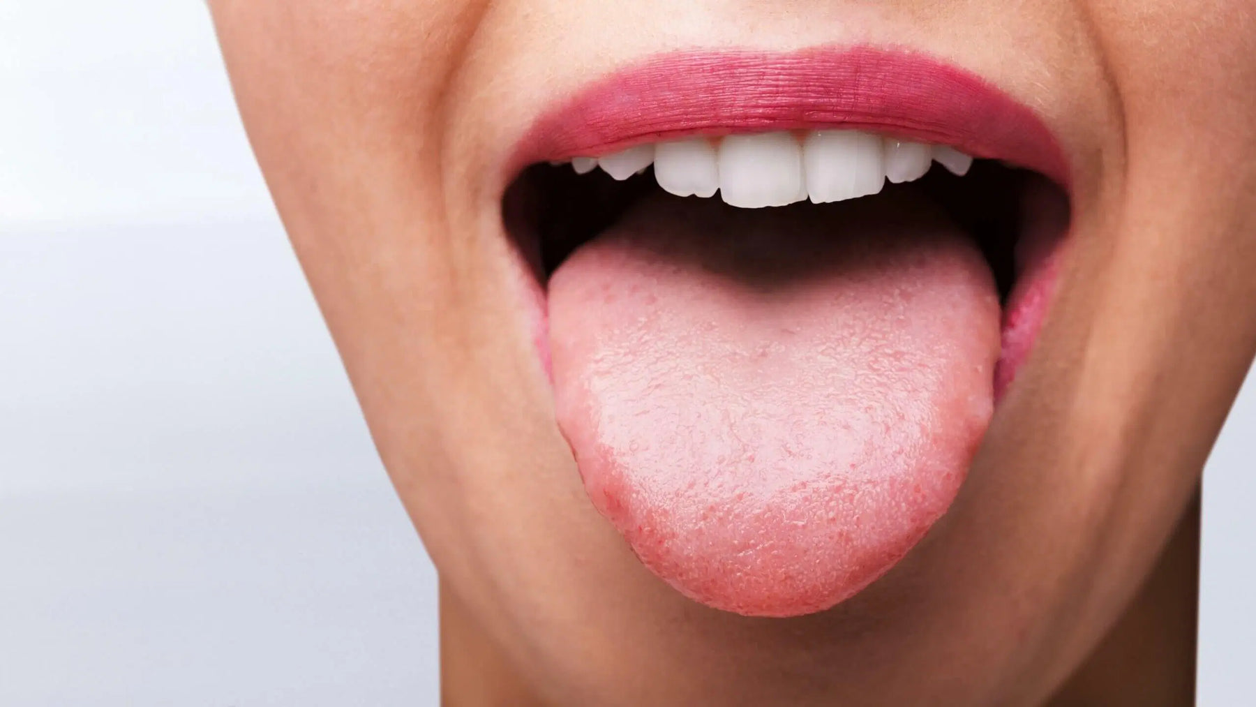 Candida: Why It's an Immune Problem, Not an Overgrowth Problem